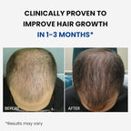 ForHair- Men Hair Growth Spray – Stimulates New Hair, Strengthens Follicles – Local Regrowth Action, No Unwanted Body Hair – Safe and Easy Alternative to Pills,Costly and Painful Treatments