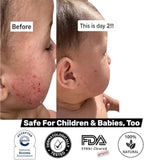 Loma Lux New Eczemol OTC Spray Natural & No Sting Hypochlorous for Eczema, Wounds, Burns, Cuts, Radiation Dermatitis, Skin Irritation, Sunburn, Itchy Skin, for Kids & Adults (8 Fl Oz.)
