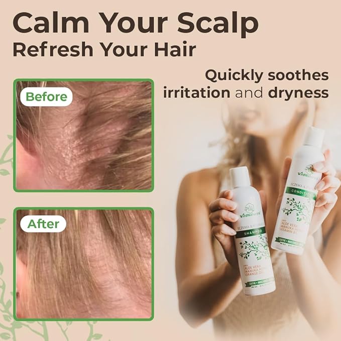 Wild Naturals Eczema and Psoriasis Treatment - Anti-Dandruff Deep Conditioner for Damaged, Dry Hair and Seborrheic Dermatitis Scalp