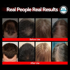 Red Light Therapy for Hair Growth, Laser Cap Red Light Higher Dose for Hair Regrowth FDA Cleared for Hair Loss Treatment LLLT Hair Thinning & Alopecia for Men Women