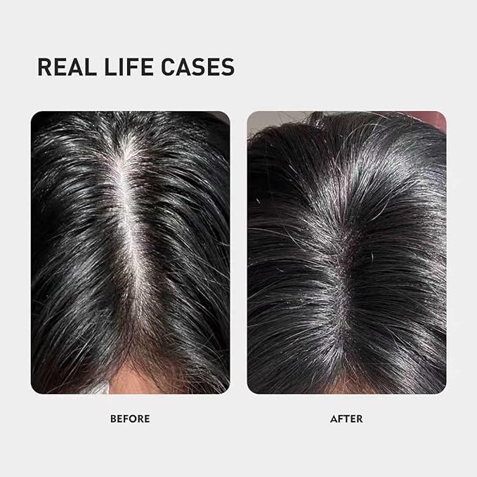 0.9% KX-826 KINTOR Hair Growth Products Foam, DHT Blocker for Men & Women Hair Regrowth, 300ml Pro