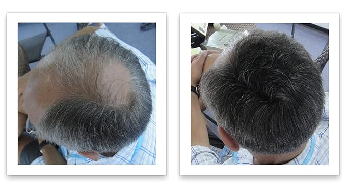 Trial Size - Eliminate Bald Spot and Thinning Hair Instantly. Make Thin Hair Look 10X Fuller. All-Natural Hair Thickening Fiber. Salt & Pepper - Dark