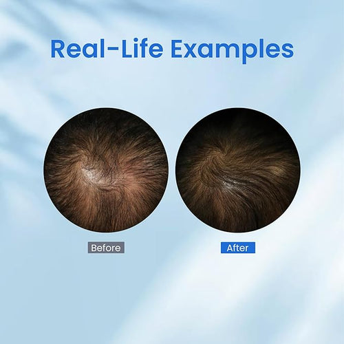 0.5% KX-826 Hair Growth Spray DHT Blocker Hair Thickening Regrowth Treatments,Oil Control Hair Loss Reduction 3-6 Months New Hair Visible,Hair Growth Products Men&Women-3 Month Supply 180ml