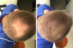 Quick Fix For Thinning Hair and Bald Spot. Get 10X Fuller Hair Instantly. All-Natural Hair Building Fiber For Hair. Trial Size (10-Day Supply). Light Brown