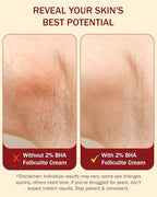 Folliculitis Cream – Folliculitis Treatment for Red Bumps, Ingrown Hairs & Razor Irritation – 2% BHA, Tea Tree, Salicylic Acid, Turmeric & Aloe – Scalp Acne treatment (4 oz)