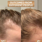 Red Light Therapy for Hair Growth, Quick-Release Panels & Portable Design, Laser Hair Growth Cap, Hair Loss Treatments Hat