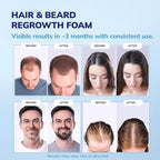 5% Minoxidil Foam for men and women, Extra Strength Hair Regrowth Treatment for Thinning Hair and Hair Loss, Hair Follicle Health – Thicker, Fuller Hair Growth Solution 6 FL.OZ