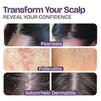 Psoriasis Shampoo for Eczema, and Folliculitis Treatment - Seborrheic Dermatitis Antifungal Shampoo for Ringworm, Acne, Flaking, Dry & Itchy Scalp Treatment - Psoriasis Relief with Manuka Honey