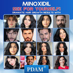 Minoxidil for Men and Women Foam Hair Growth - 5% Minoxidil Foam Hair Regrowth Treatment for Men, Topical Hair Loss Treatments, Extra Strength Thicker & Fuller Hair, 4 x 2.11 oz for 4 Months