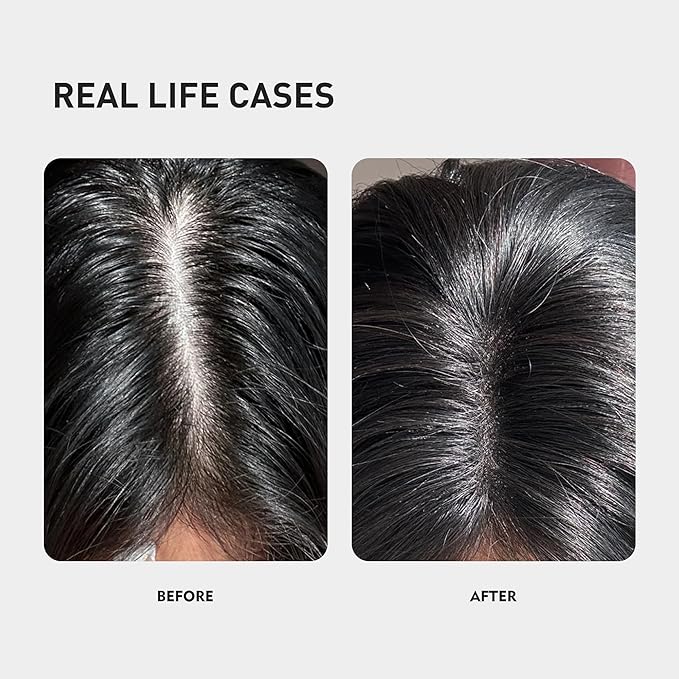 0.9% KX-826 KINTOR Hair Growth Spray,Strengthen Hair Nourish Hair follicles,Hair Care Products for Sparse Hair and Oily Hair Men&Women,300ml,Pro