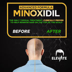 ELEVATE 5% Minoxidil Hair Growth Spray - Alcohol Free Non Oily Formula Extra Strength Professional Treatment for Hair Loss/Regrowth - Stimulate Hair Follicles for Men & Women - 1 Month Supply