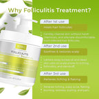 Folliculitis Deep Conditioner | Effective Scalp Treatment for Seborrheic Dermatitis, Psoriasis, Dry Itchy Scalp, Dandruff Treatment | Nourishes Oily Hair and Promotes Healthy, Hydrated Hair Treatment