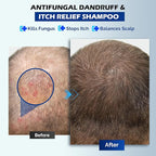 Antifungal Shampoo for Seborrheic Dermatitis, Folliculitis & Scalp Psoriasis, Anti-Dandruff Shampoo for Men & Women, Relieves Scalp Itching, Dryness, Sulfate & Paraben-Free, 10.1 Fl Oz-Fresh
