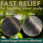 Tea Tree Scalp Scrub | Antifungal Itchy Scalp Treatment with Tea Tree Oil, Quartz Powder & Sea Salt | Gently Exfoliates, Relieves Dryness, Fights Dandruff, Promotes Healthy Hair Growth & Scalp Relief
