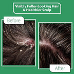 Scalp Serum with Charcoal + Tea Tree - Non GMO Scalp Moisturizer for Dry Itchy Scalp Relief - Fragrance Free Serum with Tea Tree Oil for Scalp Treatment - Rejuvenating Hair Serum with Vitamin